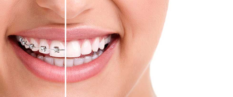 close up of woman smiling, with each half of her smile showing how she looks before and after braces